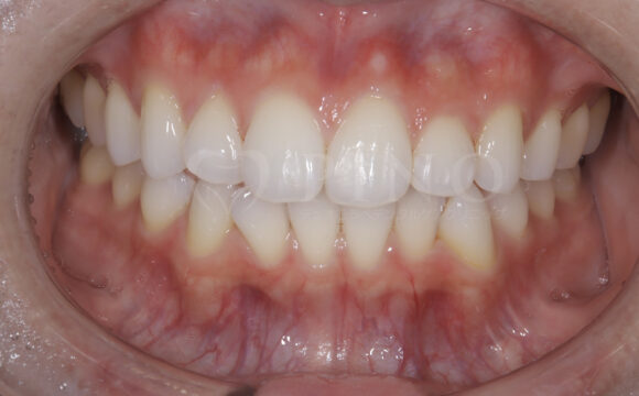 20代・女性　歯の内部の黄ばみサムネイル