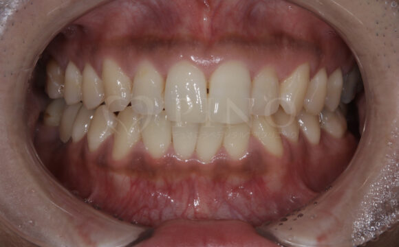 20代・男性　歯の内部の黄ばみサムネイル
