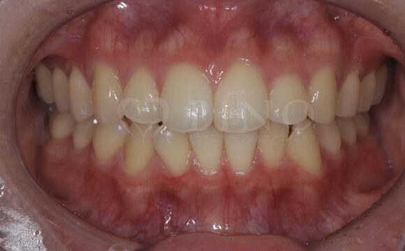 20代・女性　歯の内部の黄ばみサムネイル