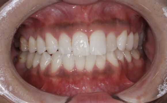 20代・男性　歯の内部の黄ばみサムネイル