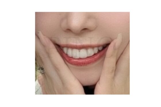 PINOスタッフ体験談！マウスピース矯正のメリットって？サムネイル