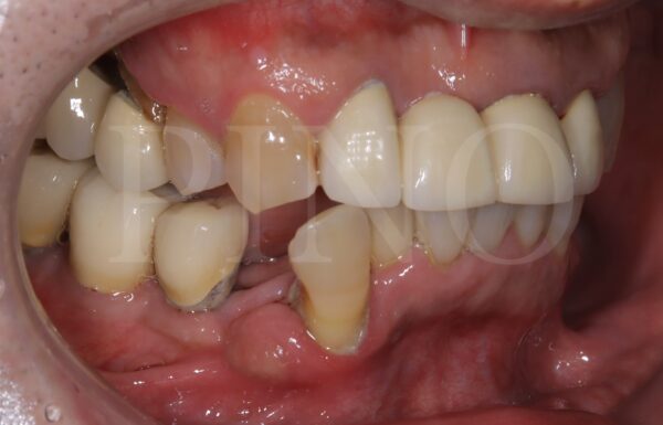 歯周病って治るの？歯周病の症状と原因とはサムネイル