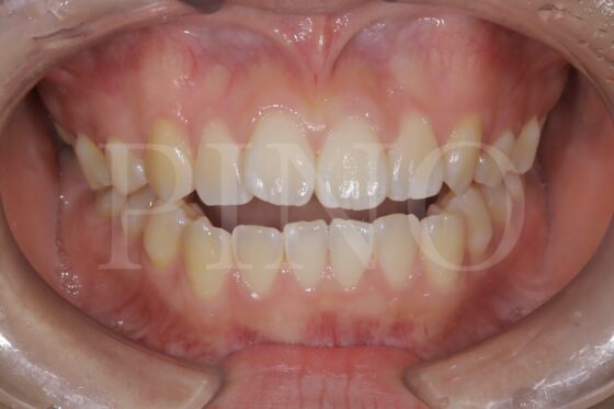 歯並びが悪くなる生活習慣！5選！【原因と対策】サムネイル