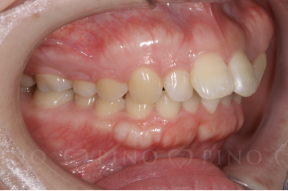 歯科矯正が必要な歯並びの種類や治療の方法を解説！サムネイル