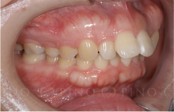 歯科矯正が必要な歯並びの種類や治療の方法を解説！サムネイル