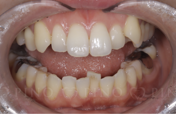 歯科矯正でなぜ抜歯が必要なの？理想の歯並びになるための方法を歯科医が解説！サムネイル