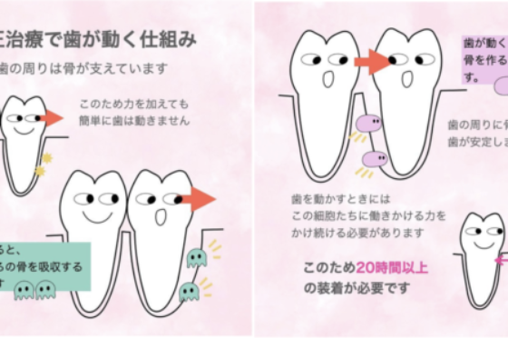 マウスピース矯正で大切な『装着時間』とは！サムネイル