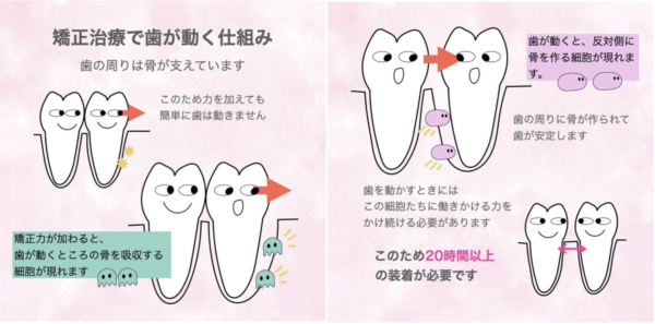 マウスピース矯正で大切な『装着時間』とは！サムネイル