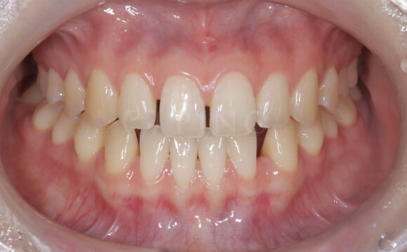 すきっ歯が気になる(20代女性)サムネイル