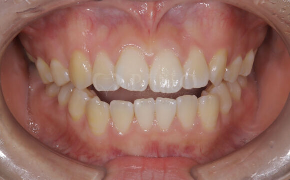 前歯が噛み合わないのが気になる(20代女性)サムネイル