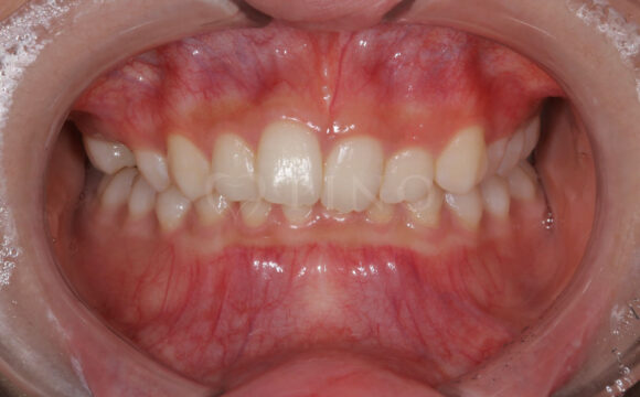 噛み合わせが深く、下の歯が見えないのが気になる(10代女性)サムネイル