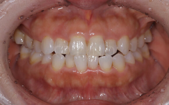 ワイヤー矯正後の後戻りが気になる(40代女性)サムネイル