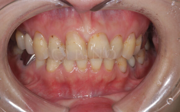 ワイヤー矯正後の後戻りが気になる(50代女性)サムネイル