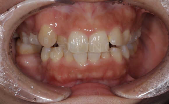 歯並びが気になる、歯がないところも治したい(50代女性)サムネイル