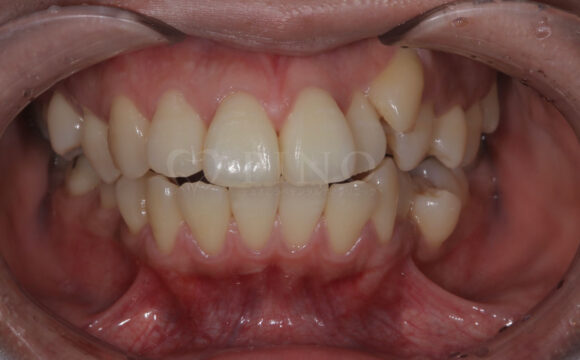 八重歯と歯がガタガタして気になる(20代女性)サムネイル