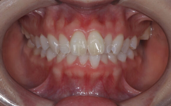 口元が出ている(出っ歯、口ゴボ)のが気になる(20代女性)サムネイル