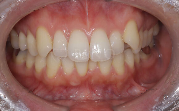 歯が全体的にガタガタして気になる(30代女性)サムネイル