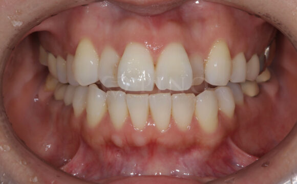 歯が全体的にガタガタして気になる(30代女性)サムネイル